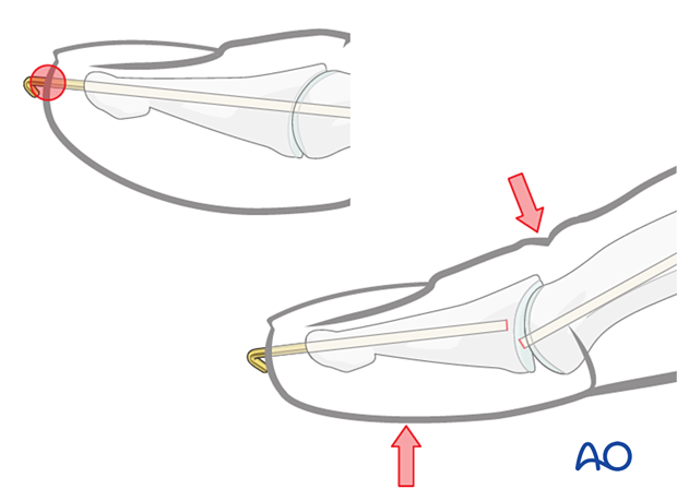 Percutaneous pinning of the DIP joint with the risk of infection and K-wire breakage