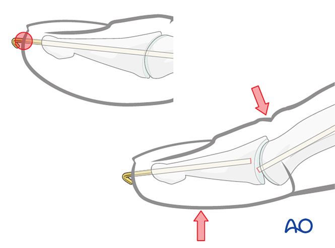 Joint Transfixation With K Wire For Dorsal Avulsion Injuries Of The