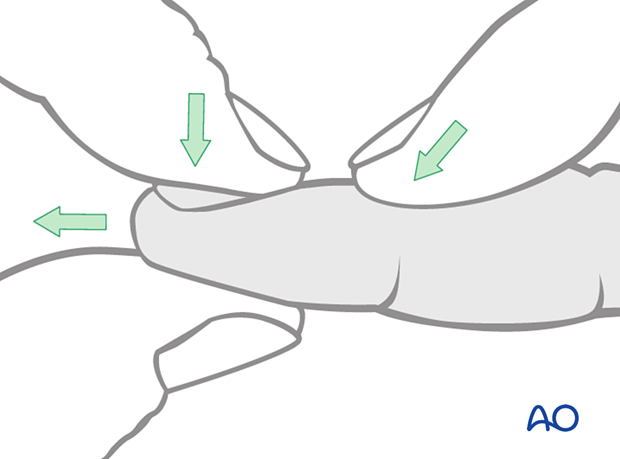 Manual reduction of dorsal subluxations of the DIP joint