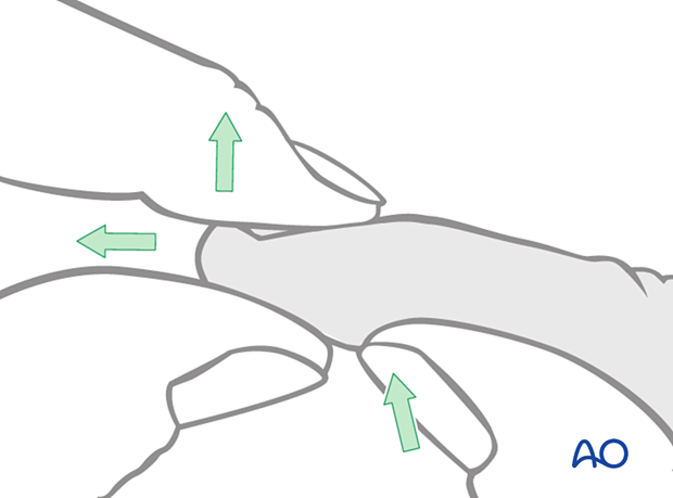 Manual reduction of palmar subluxations of the DIP joint