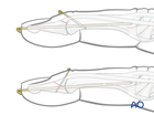 Extensor block pinning and K-wire fixation (with joint transfixation) to stabilize a dorsal avulsion fracture of the distal phalangeal base