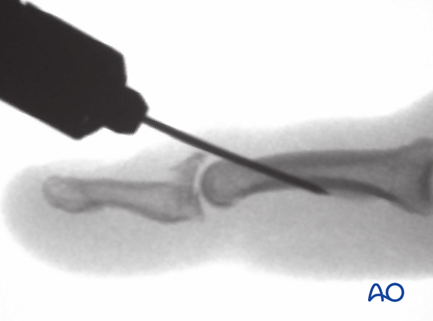 Intraoperative lateral view of a K-wire inserted through the terminal extensor tendon into the head of the middle phalanx