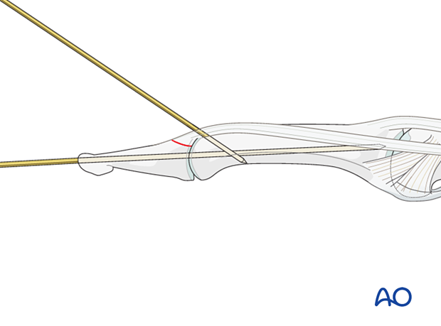 K-wire transfixation of the DIP joint and a K-wire inserted through the terminal extensor tendon into the head of the middle phalanx