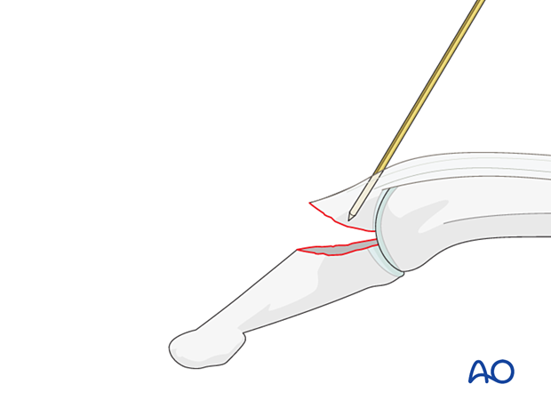 K-wire insertion into the dorsal avulsion fragment of the distal phalangeal base