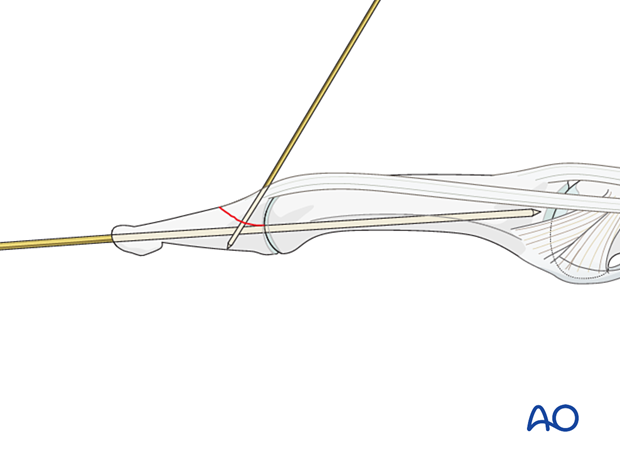 K-wire transfixation of the DIP joint and K-wire fixation of the dorsal avulsion fragment of the distal phalangeal base