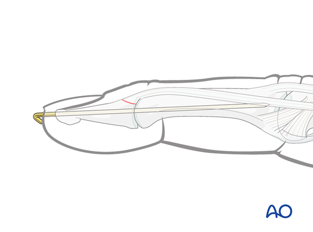 DIP joint transfixation with a K-wire