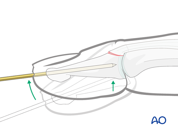 K-wire reduction of a palmar subluxation of the DIP joint and the dorsal avulsion fracture