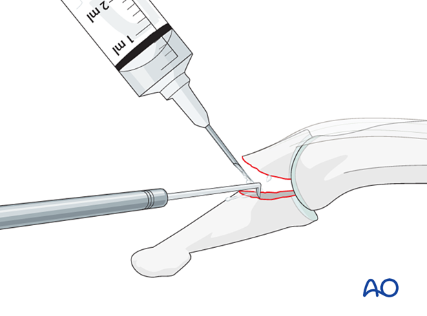 Removal of blood clots and debris off a dorsal avulsion fracture of the distal phalangeal base