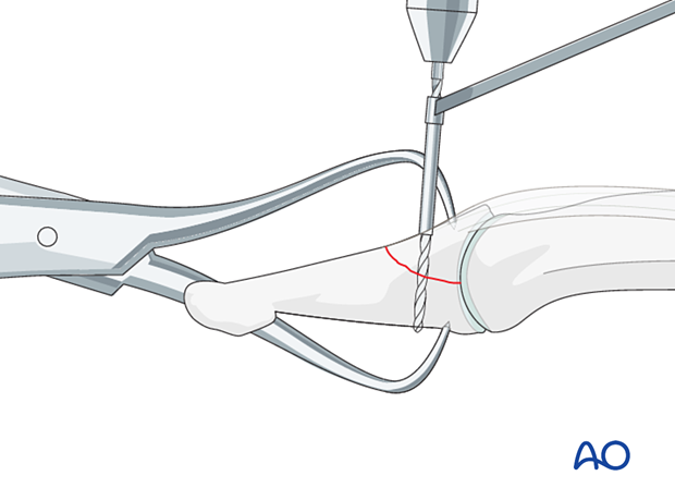 Drilling for screw fixation of a dorsal avulsion fracture of the distal phalangeal base