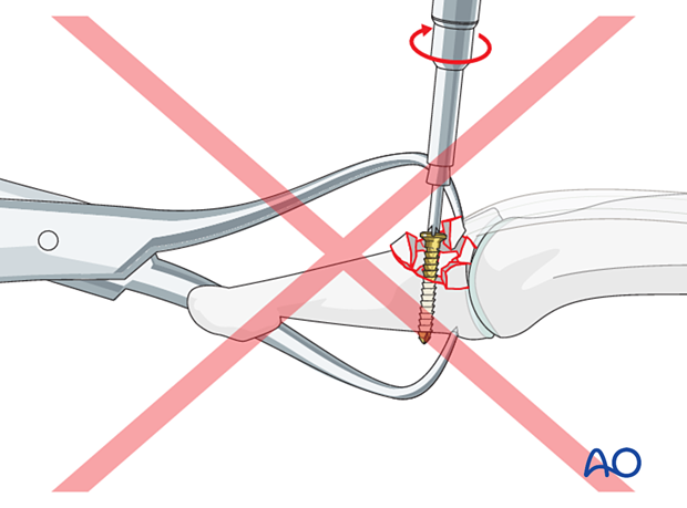 Overtightening the screw during fixation of a dorsal avulsion fracture of the distal phalangeal base