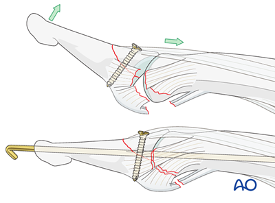 Screw fixation for Dorsal avulsion injury of the proximal end segment ...