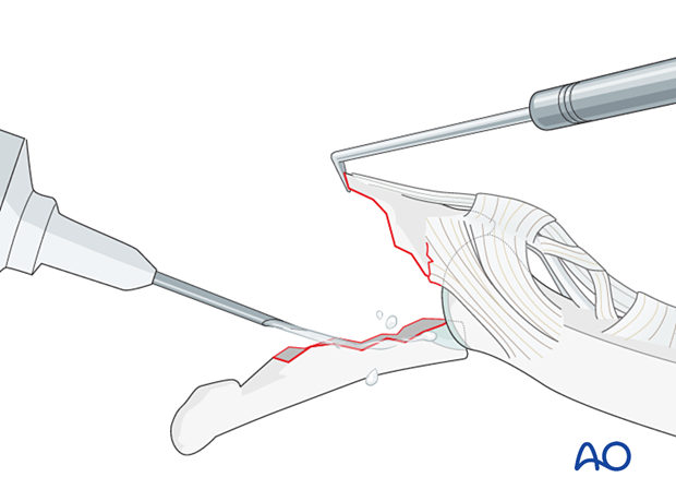 Removal of blood clots and debris off a palmar avulsion fracture of the distal phalangeal base