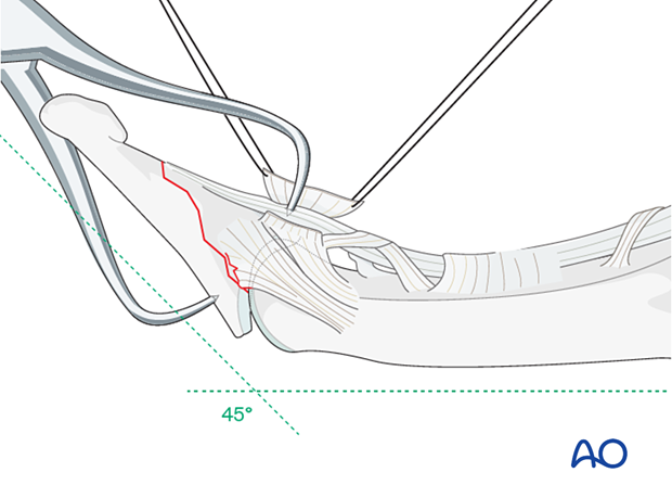 Reduction of a palmar avulsion fracture of the distal phalangeal base with forceps