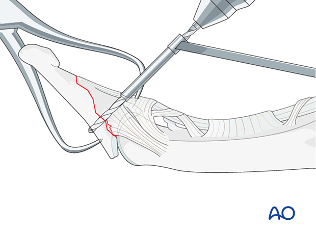 Drilling for screw fixation of a palmar avulsion fracture of the distal phalangeal base