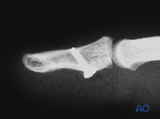 Lateral x-ray of screw fixation of a palmar avulsion fracture of the distal phalangeal base