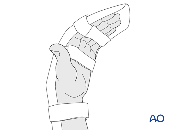 Resting splint with the wrist in 30° flexion, the MCP joint in 70°–90° flexion, and the PIP joint in extension