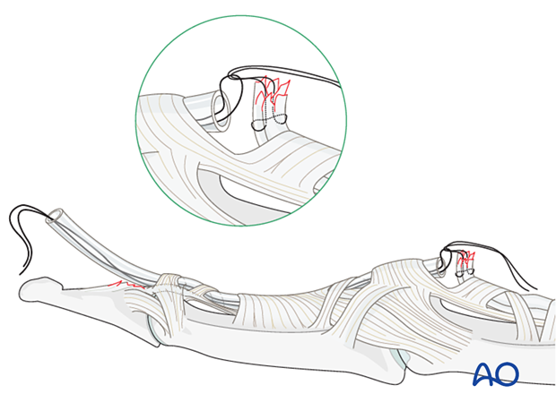 Repositioning the avulsed flexor digitorum profundus (FDP) tendon
