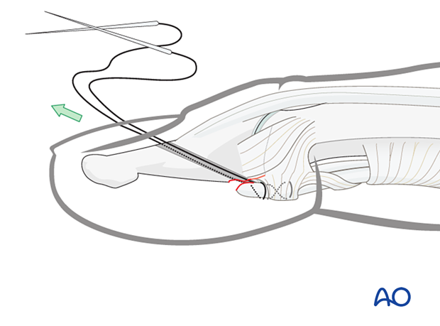 Reduction of the flexor digitorum profundus (FDP) tendon with the suture