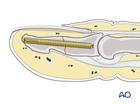Fixation of a simple transverse shaft fracture of the distal phalanx with a cannulated screw