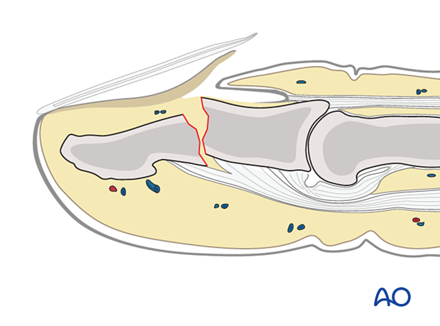 Open fractures of the distal phalangeal shaft