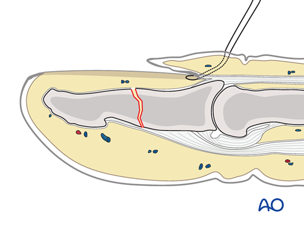 Reinsertion of the nail bed with a suture