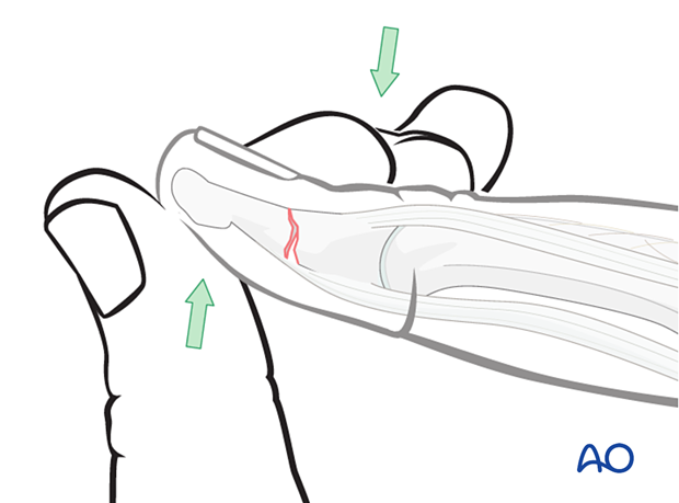 Manual reduction of a simple transverse fracture of the distal phalangeal shaft