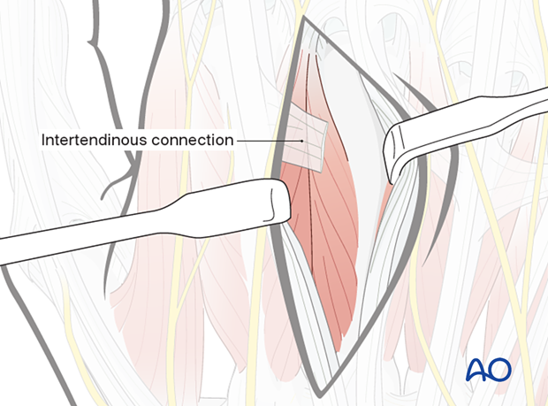 Retraction of extensor tendons during a dorsal approach to the metacarpals