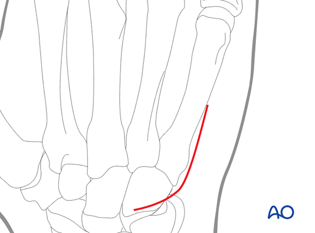 77_A040_i010 Dorsal approach to the 5th carpometacarpal joint