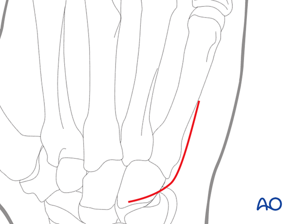 Skin incision of a dorsal approach to the 5th carpometacarpal joint