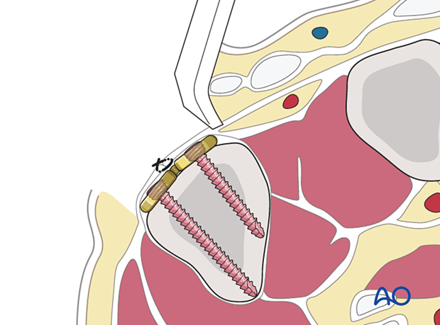 Cross section showing periosteum covering a plate fixation at the 5th metacarpal base