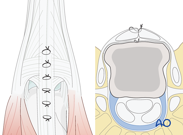 Joint capsule and tendon repair with sutures