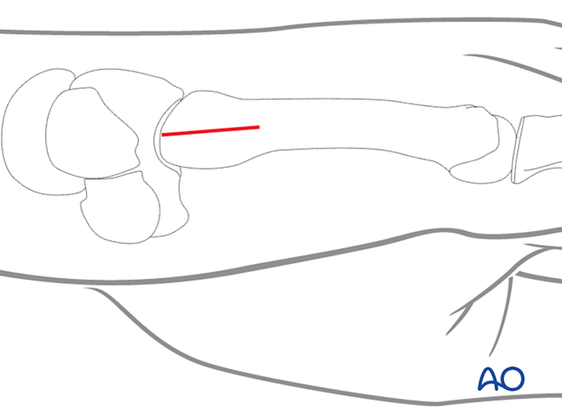 Skin incision of a dorsoulnar approach to the 5th metacarpal base