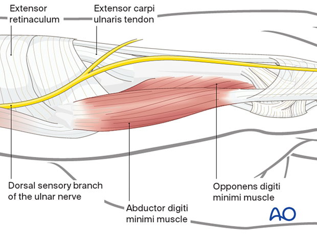 Dorsoulnar view of the surgical anatomy around the 5th metacarpal base