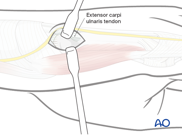 Exposure of the 5th metacarpal base