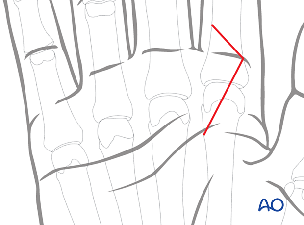 Volar approach to the metacarpophalangeal joint of the 2nd ray