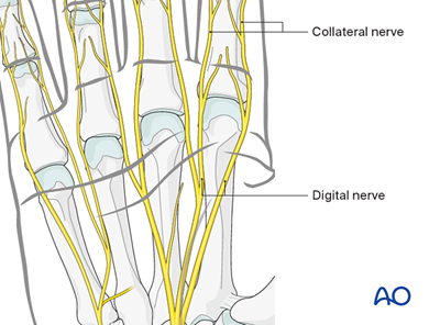 Volar approach to the metacarpophalangeal joint