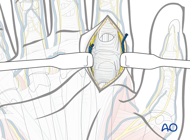 Exposure of the retinaculum and A1 pulley during a volar approach to the metacarpophalangeal joint of the 2nd ray