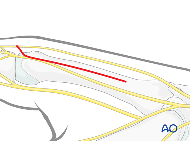 Skin incision of a radial approach to the 2nd metacarpal