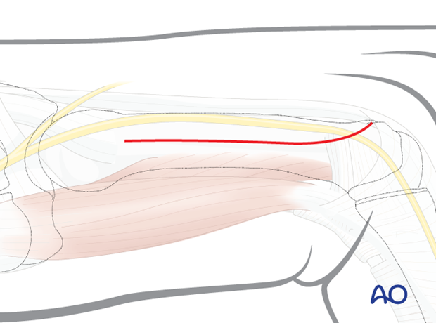 Skin incision of a dorsoulnar approach to the 5th metacarpal