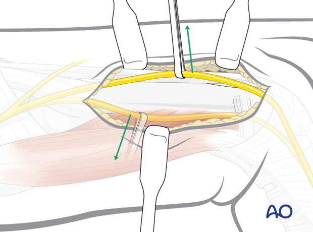 Exposure of the 5th metacarpal diaphysis and mobilization of the dorsal sensory branch of the ulnar nerve