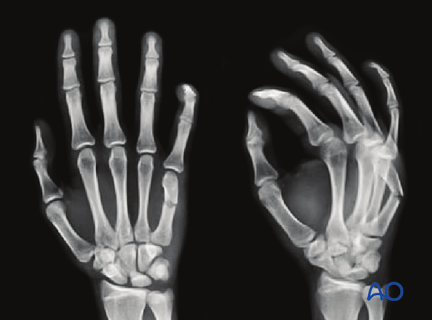 AP and oblique x-ray of a transverse metacarpal shaft fracture