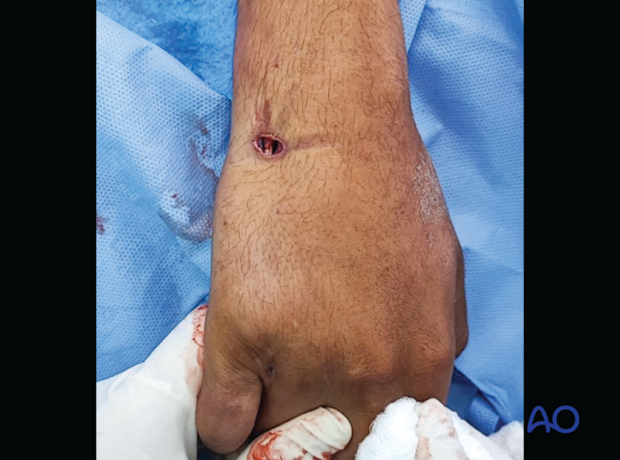 Entry point for intramedullary screw fixation of a 5th metacarpal shaft fracture