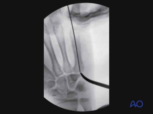 Intraoperative image showing the guide wire for intramedullary screw fixation of the 5th metacarpal shaft fracture