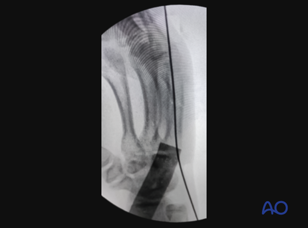 Intraoperative image showing the guide wire for intramedullary screw fixation of the 5th metacarpal shaft fracture