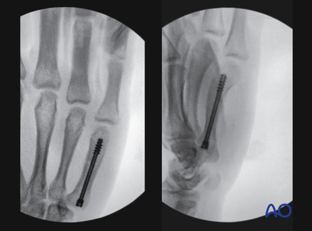 Intraoperative image showing  intramedullary screw fixation of the 5th metacarpal shaft fracture