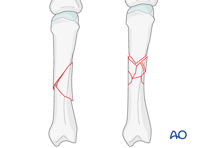 Wedge or multifragmentary fracture of the diaphysis