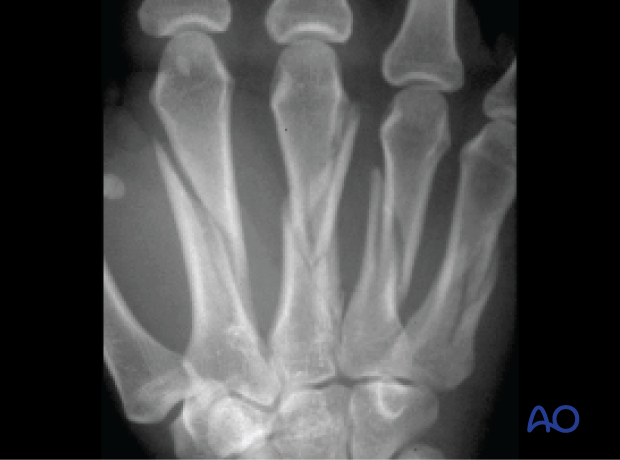 77 P252 Bridge plating