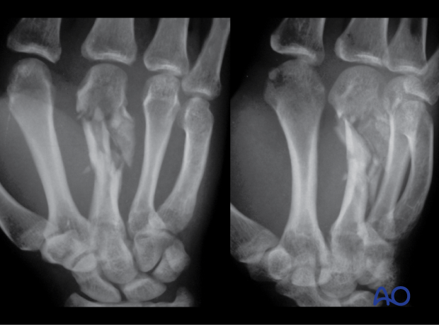 AP and oblique x-ray of a multifragmentary fracture of the 3rd metacarpal shaft