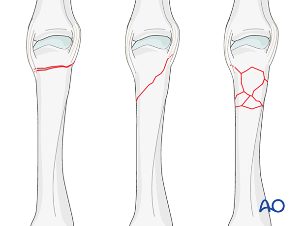 Extraarticular fracture of the metacarpal head