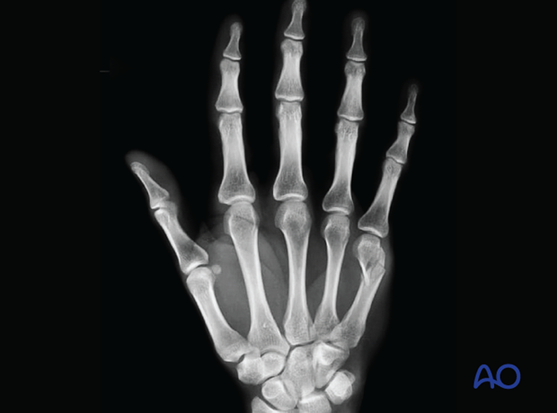 AP x-ray of the hand showing an extraarticular fracture of the distal end segment